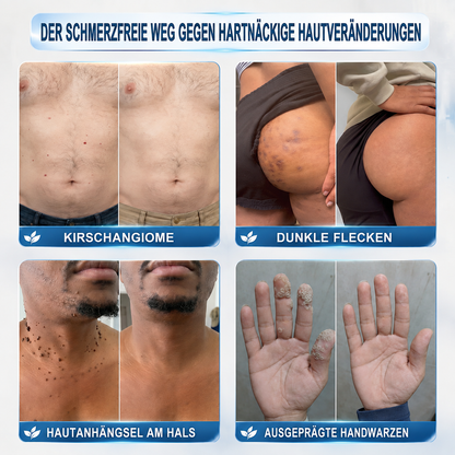 🇩🇪✨🌿 Celsiora® 7-Tage Warzen- & Hautanhängsel-Entfernungsschaum (Gezielte Pflege bei Warzen, Hautanhängseln & unebenem Hautbild)