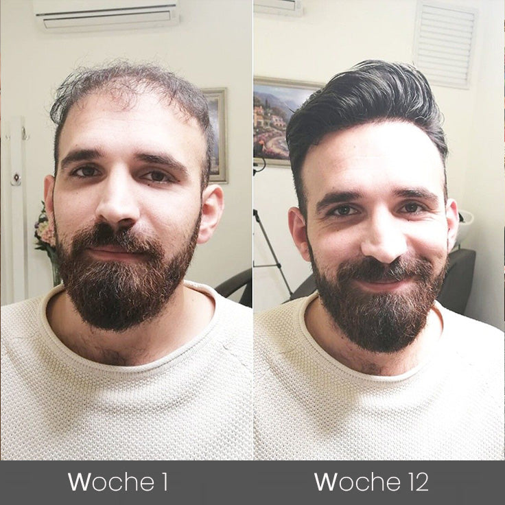 ✅👨‍⚕️Offizieller Store 🇩🇪 | 🔥Rolimey® Hochwirksames Biotin & Rosmarin Haarwachstumsserum– Füllt lichte Stellen & Geheimratsecken sichtbar auf (🔥Zeitlich begrenzter Rabatt, ⏳letzte 30 Minuten)