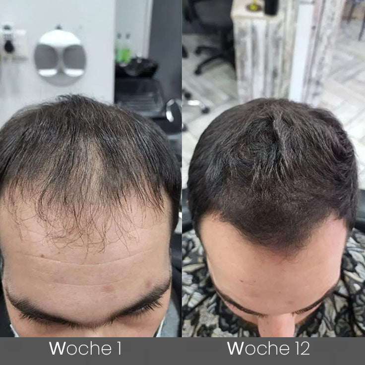 ✅👨‍⚕️Offizieller Store 🇩🇪 | 🔥Rolimey® Hochwirksames Biotin & Rosmarin Haarwachstumsserum– Füllt lichte Stellen & Geheimratsecken sichtbar auf (🔥Zeitlich begrenzter Rabatt, ⏳letzte 30 Minuten)