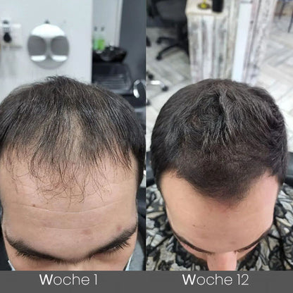 ✅👨‍⚕️Offizieller Store 🇩🇪 | 🔥Rolimey® Hochwirksames Biotin & Rosmarin Haarwachstumsserum– Füllt lichte Stellen & Geheimratsecken sichtbar auf (🔥Zeitlich begrenzter Rabatt, ⏳letzte 30 Minuten)