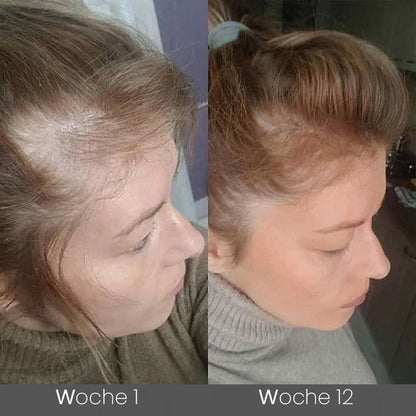 ✅👨‍⚕️Offizieller Store 🇩🇪 | 🔥Rolimey® Hochwirksames Biotin & Rosmarin Haarwachstumsserum– Füllt lichte Stellen & Geheimratsecken sichtbar auf (🔥Zeitlich begrenzter Rabatt, ⏳letzte 30 Minuten)