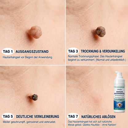 🇩🇪✨🌿 Celsiora® 7-Tage Warzen- & Hautanhängsel-Entfernungsschaum (Gezielte Pflege bei Warzen, Hautanhängseln & unebenem Hautbild)