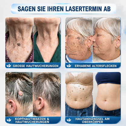 🇩🇪✨🌿 Celsiora® 7-Tage Warzen- & Hautanhängsel-Entfernungsschaum (Gezielte Pflege bei Warzen, Hautanhängseln & unebenem Hautbild)